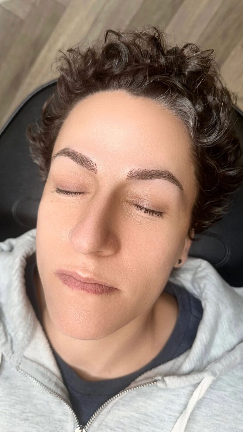[Brow technique], healed result