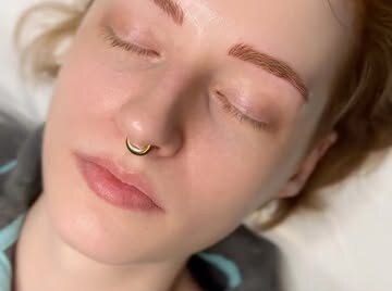 [Brow technique], healed result